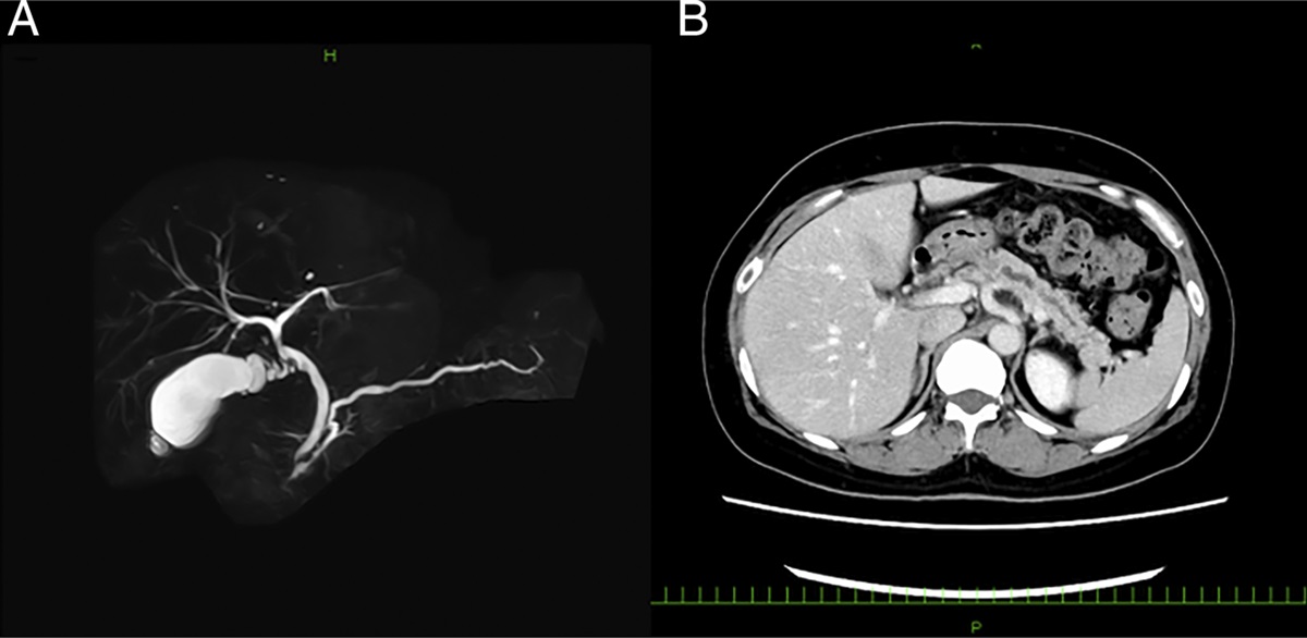 Use of Peroral Pancreatoscopy in the Diagnosis of Elusive Intraductal Papillary Mucinous Neoplasm With High-Grade Dysplasia