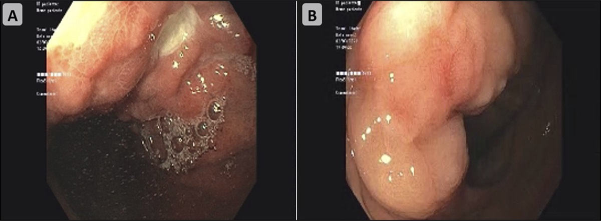Simultaneous Gastric and Colonic Metastasis of Breast Cancer