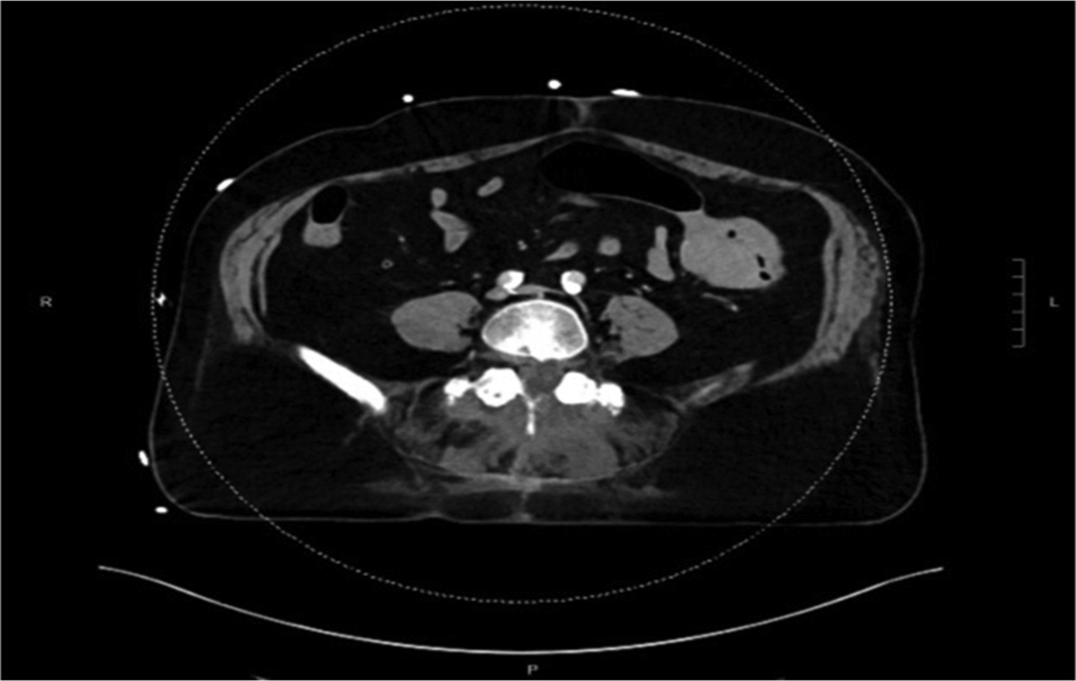 The Sigmoid Colon as an Unusual Primary Site of T Cell Lymphoma in a Patient Presenting With Brain Metastasis