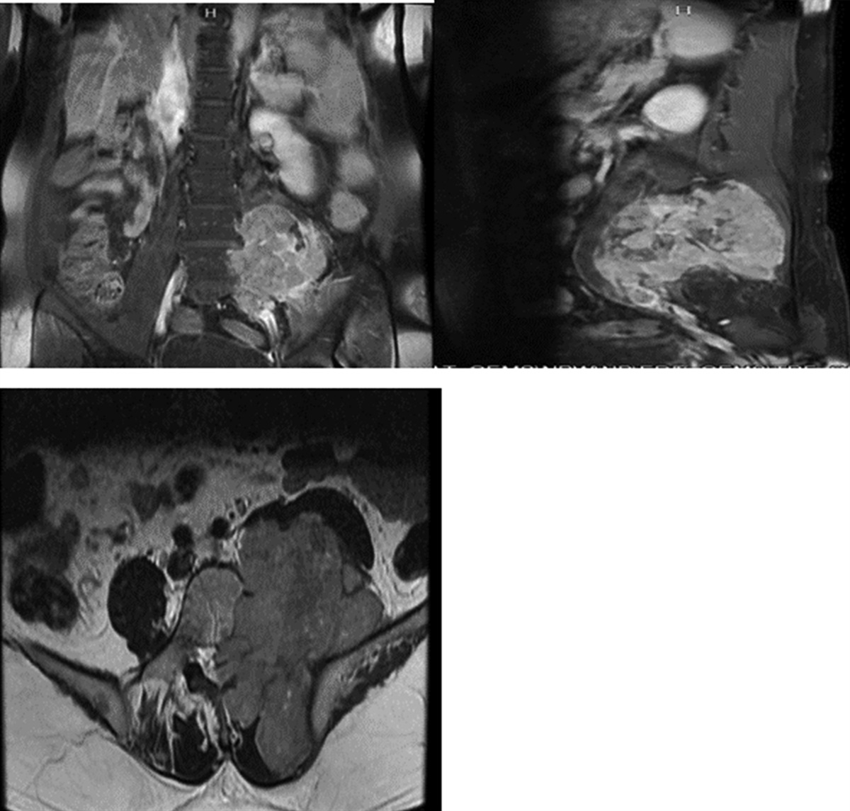 Ectopic Hepatocellular Carcinoma Manifesting as Paraspinal Mass: An Unusual Entity