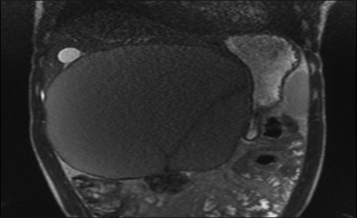 Solitary Giant Simple Hepatic Cyst