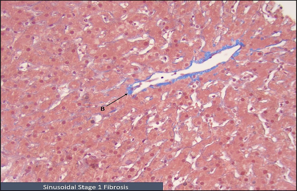 Increased Liver Enzymes: An Under-Recognized Finding in Maturity-Onset Diabetes of the Young Type 5 (MODY 5)