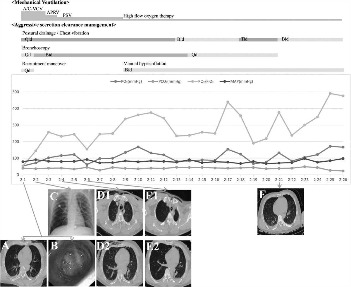 A Fast-Track Respiratory Protocol for High Cervical Spine Injury: A Case Report