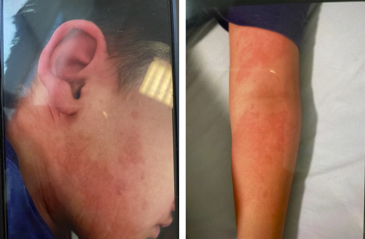 Atomoxetine-Associated Maculopapular Rash: A Case Report