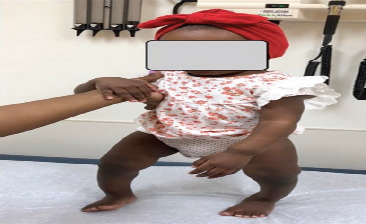 Vitamin D deficiency rickets in a toddler