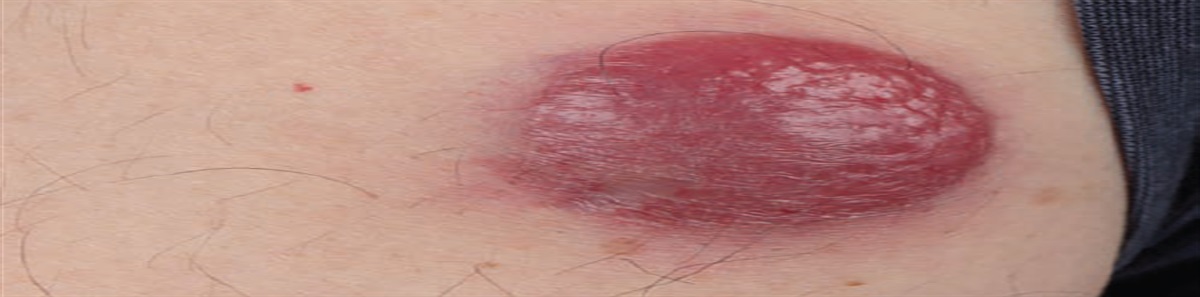 A review of Merkel cell carcinoma