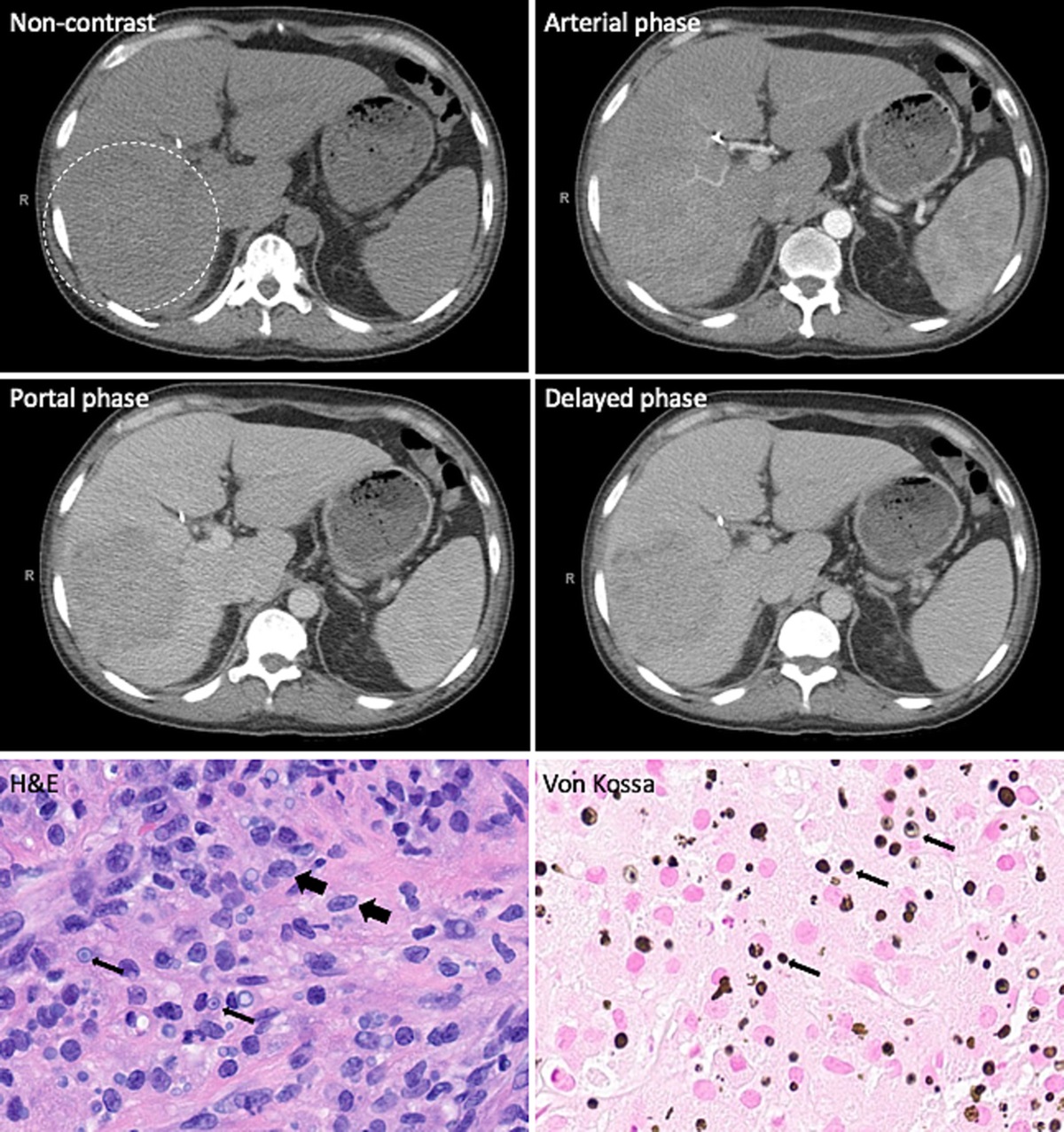 Malignant Mimicry in a Rare Case of Hepatic Malakoplakia
