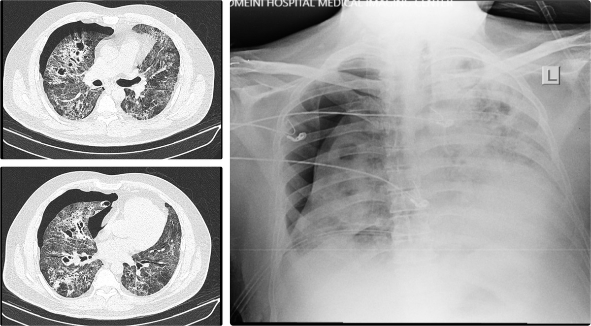 COVID-19 Patients Presenting With Pneumothorax and Bronchopleural Fistula: Incidence and Case Description