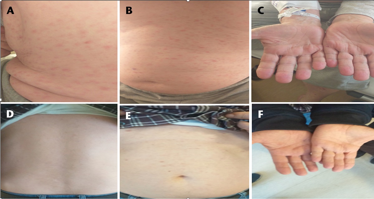 Secondary Syphilis With Pulmonary Involvement: A Case Without HIV Infection and Literature Review