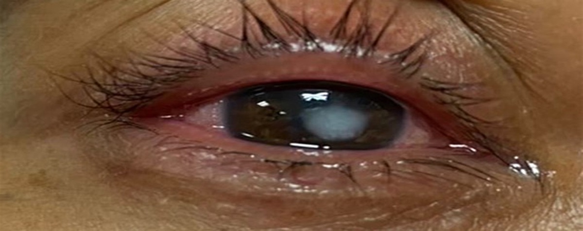 Microsporidial Stromal Keratitis, a Case Report
