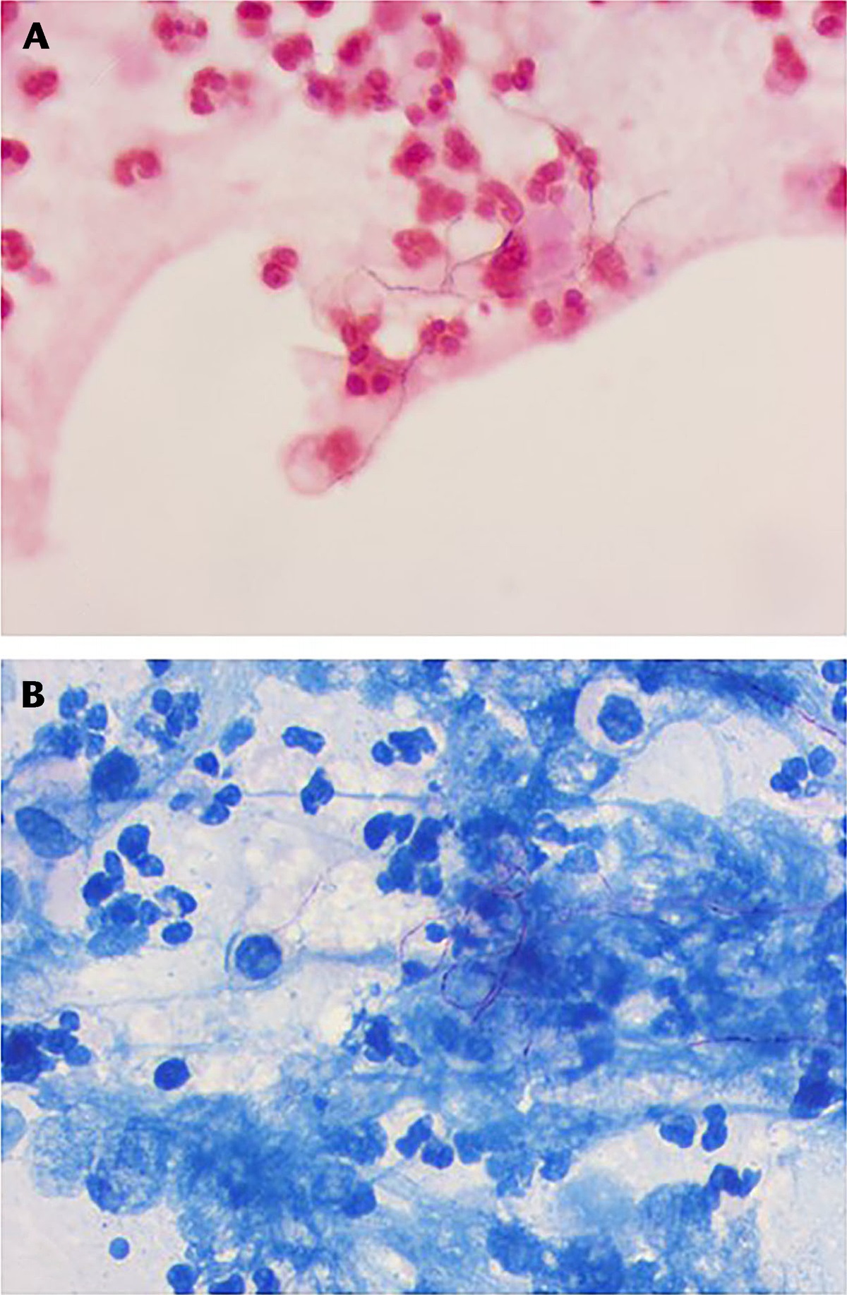 Nocardia paucivorans Endophthalmitis and Cerebral Abscesses in an Immunocompetent Patient: A Case Report