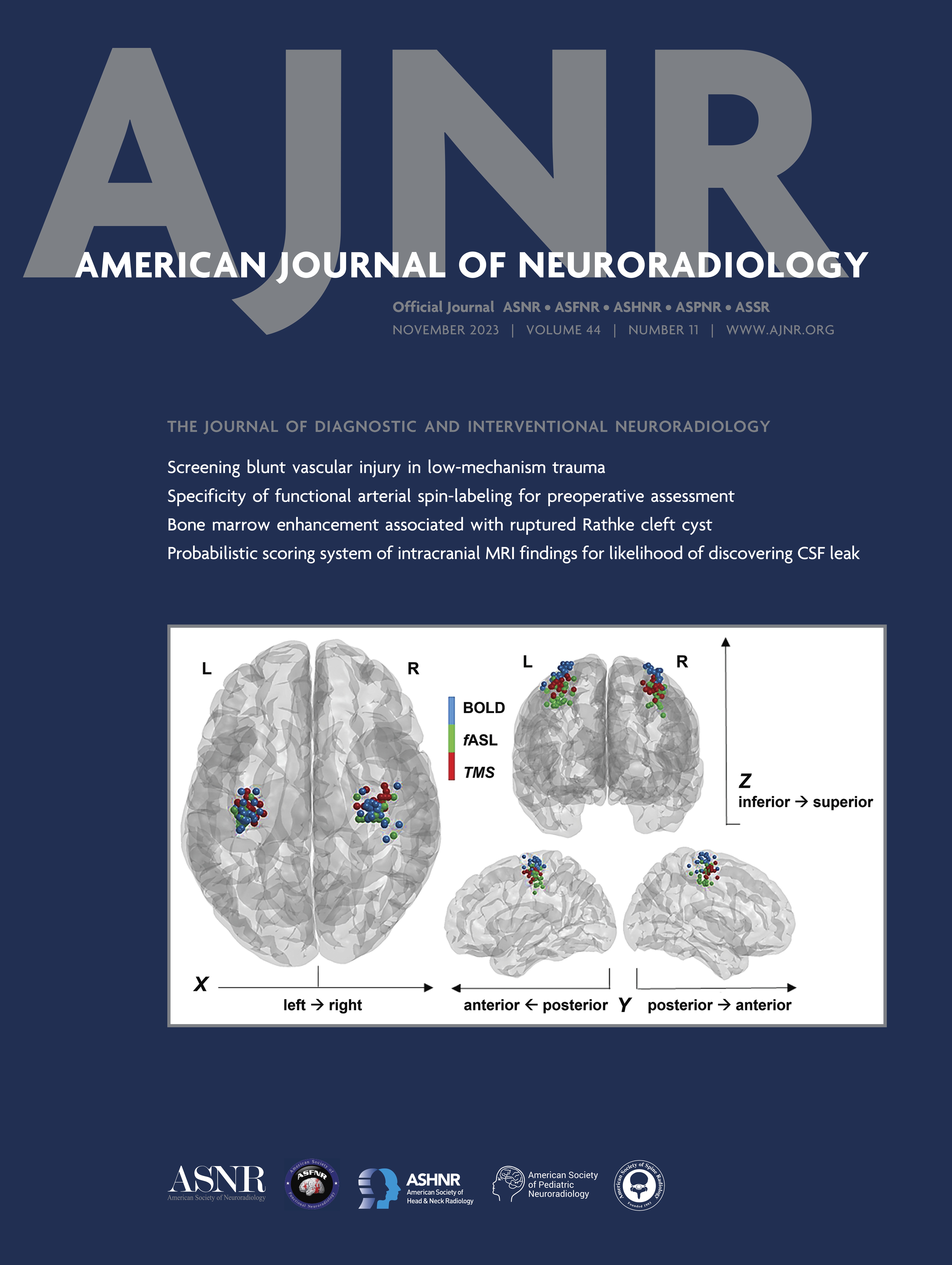 Likelihood of Discovering a CSF Leak Based on Intracranial MRI Findings in Patients without a Spinal Longitudinal Extradural Collection: A New Probabilistic Scoring System [SPINE IMAGING AND SPINE IMAGE-GUIDED INTERVENTIONS]