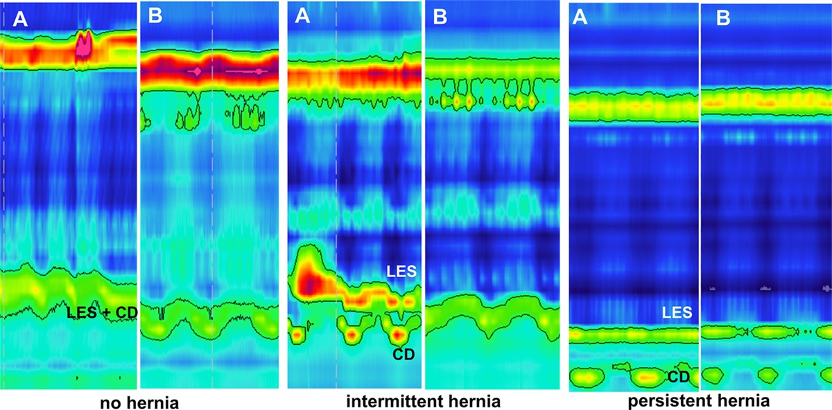 Intermittent Hiatus Hernia on High-Resolution Manometry Associates With Abnormal Reflux Burden Similar to Persistent Hiatus Hernia