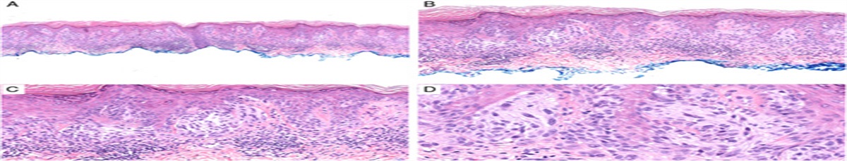 Clinical, Morphologic, and Molecular Features of Benign and Intermediate-grade Melanocytic Tumors With Activating Mutations in MAP2K1