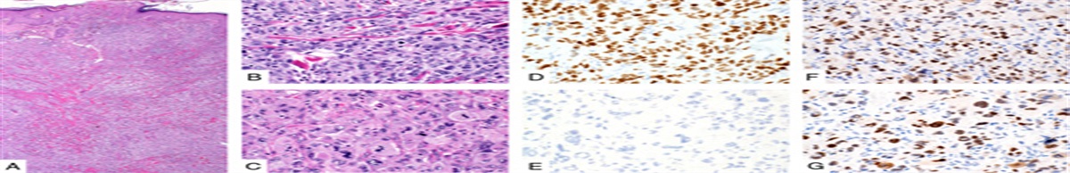 PRAME Expression Is a Useful Tool in the Diagnosis of Primary and Metastatic Dedifferentiated and Undifferentiated Melanoma