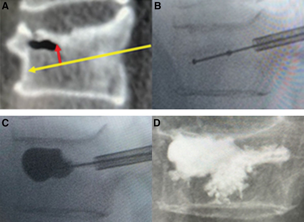 Preoperative planning of compact zone trajectory is necessary in treating osteoporotic vertebral compression fracture with endplate involvement: A prospective randomized controlled study