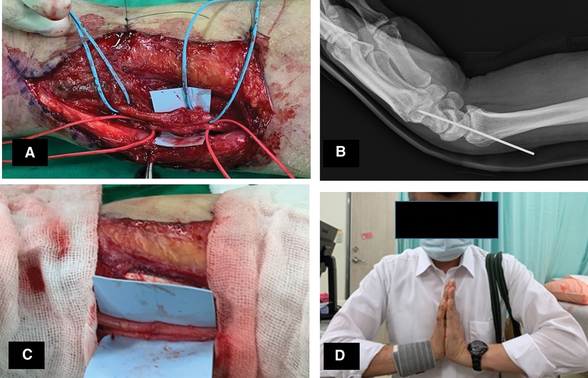 Outcomes of radiocarpal pinning to facilitate nerve repair in wrist-level ulnar nerve injuries with defect
