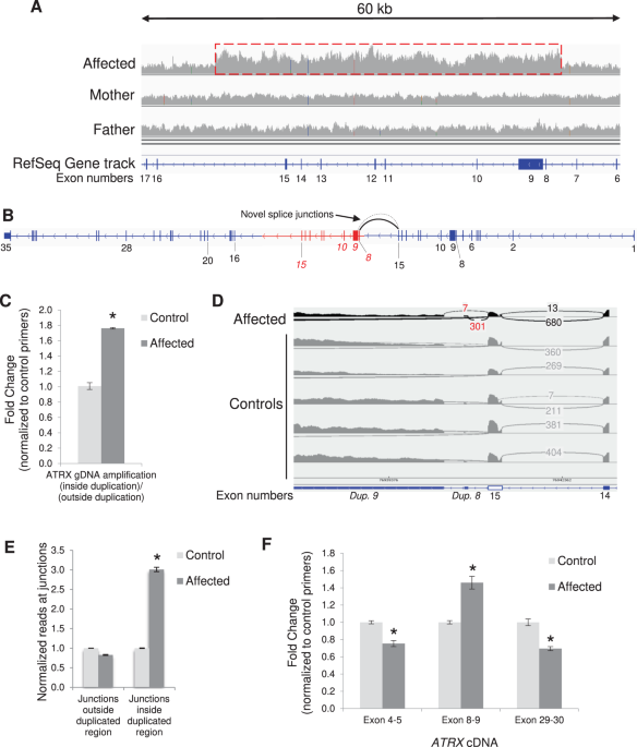 Integrated omics analyses clarifies ATRX copy number variant of uncertain significance