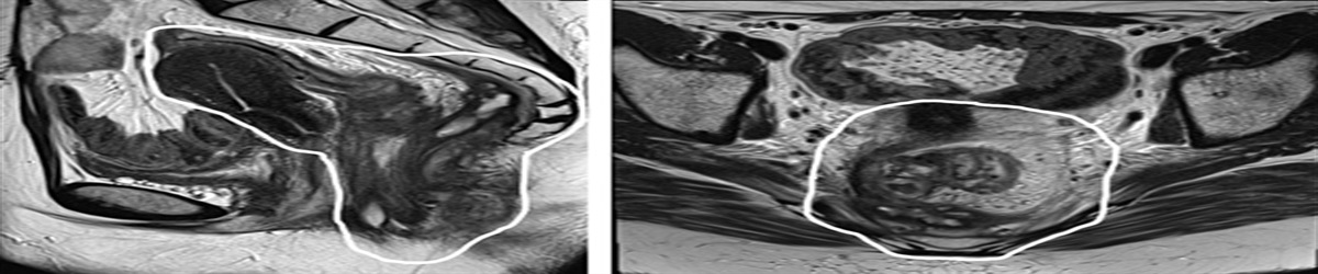 Improving Surgical Outcomes in Pelvic Exenteration Surgery: Comparison of Prone Sacrectomy With Anterior Cortical Sacrectomy Techniques