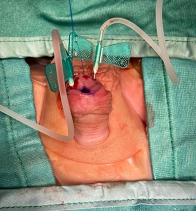 Intracavernosal pressure of the erect penis in children with hypospadias