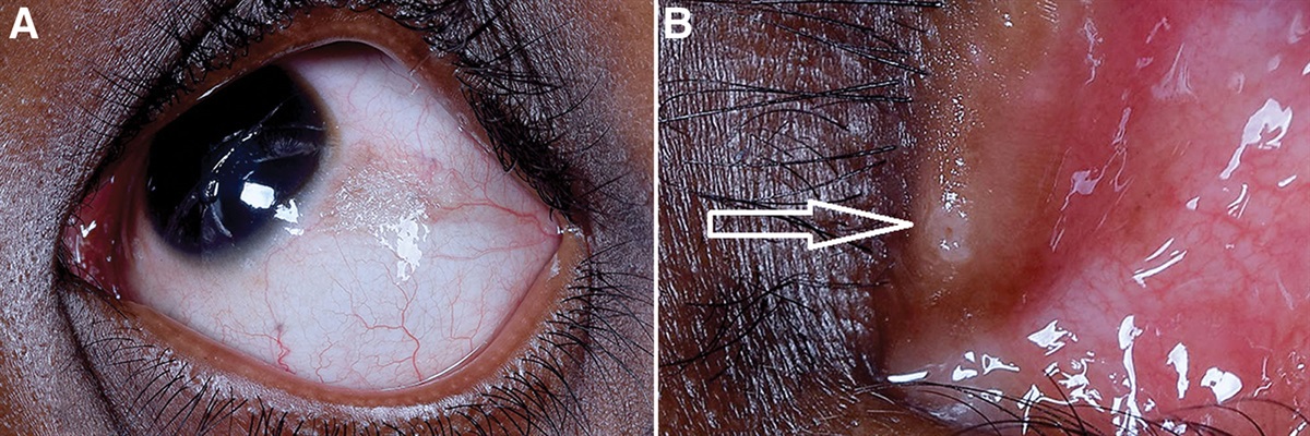 Vitamin-A Deficiency: Peripunctal Bitot’s Spots