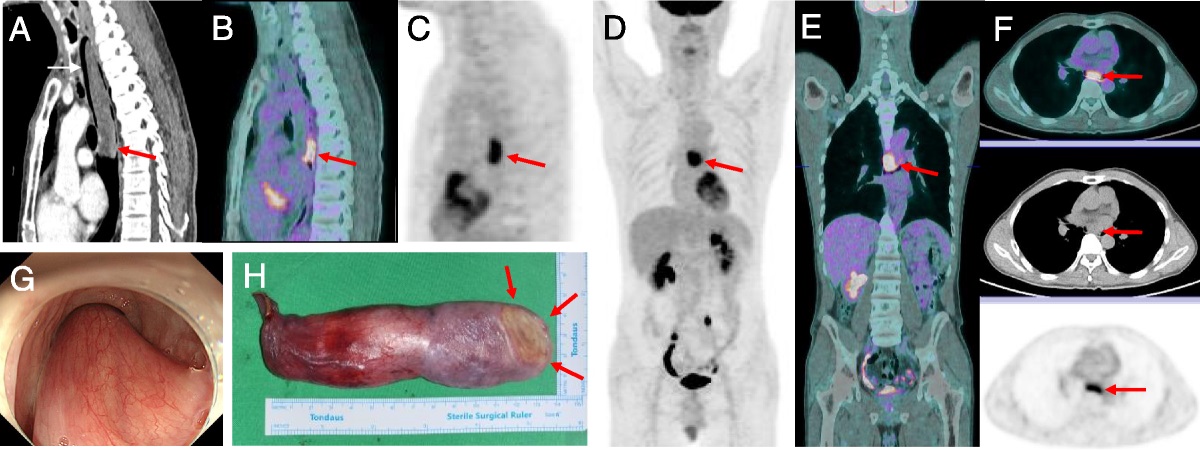Giant Fibrovascular Polyp Mimicking Esophageal Malignancy on 18F-FDG PET/CT