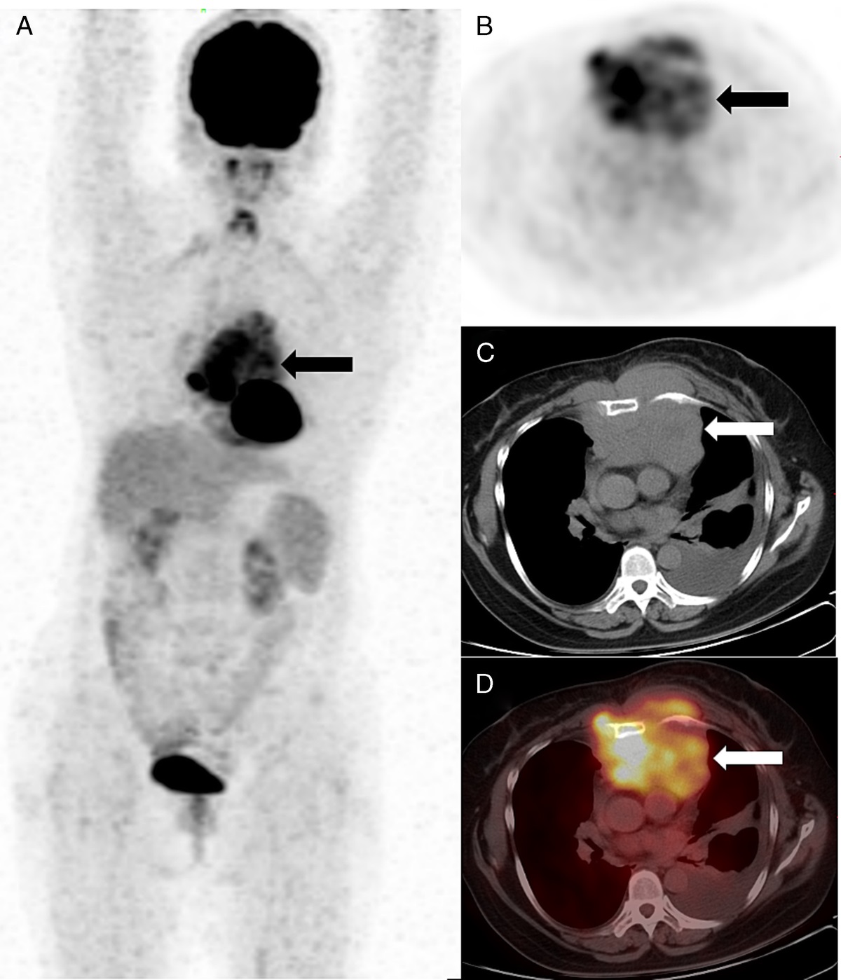 FDG PET/CT Image of Extramedullary Plasmacytoma in the Anterior Mediastinum