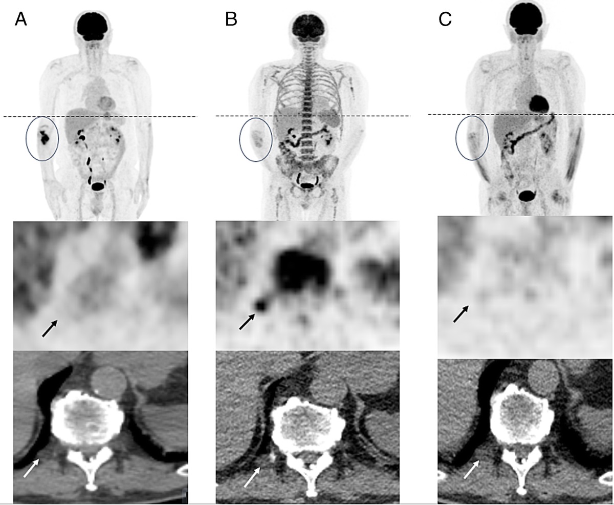 Extramedullary Hematopoiesis in Treated Diffuse Large B-Cell Lymphoma of Bone