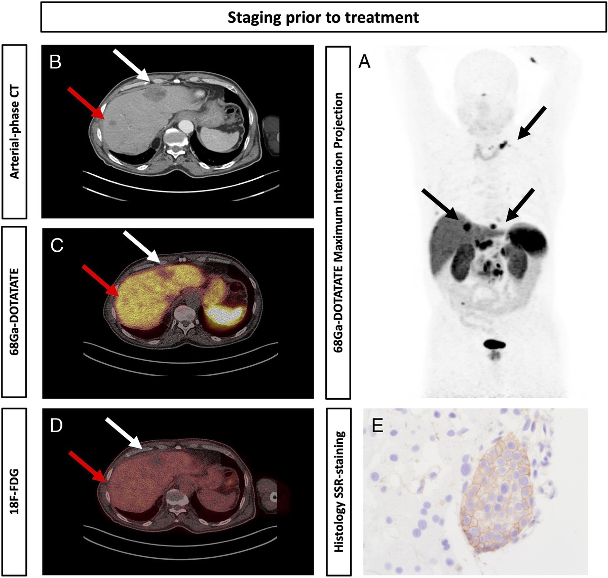177Lu-DOTATATE (Lutathera) Therapy in 68Ga-DOTATATE PET/CT-Negative Liver Metastases of a Neuroendocrine Tumor
