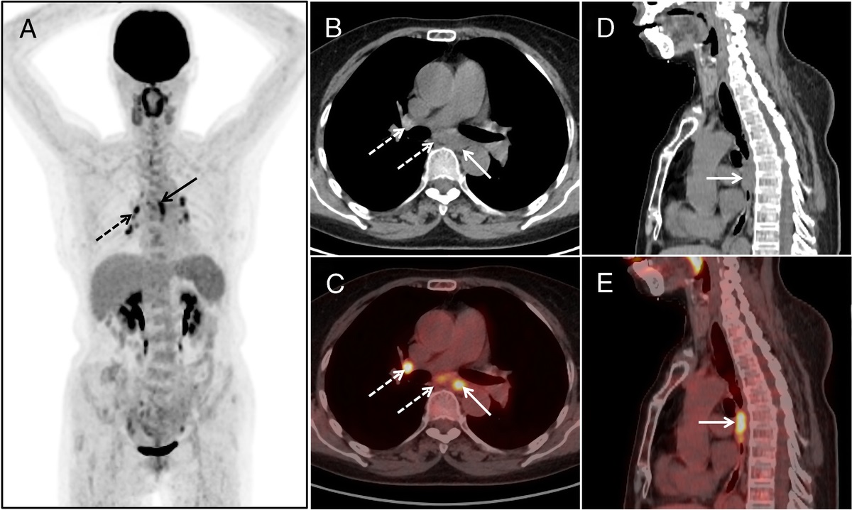 Elevated FAPI Activity in Ulcerative Fungal Esophagitis