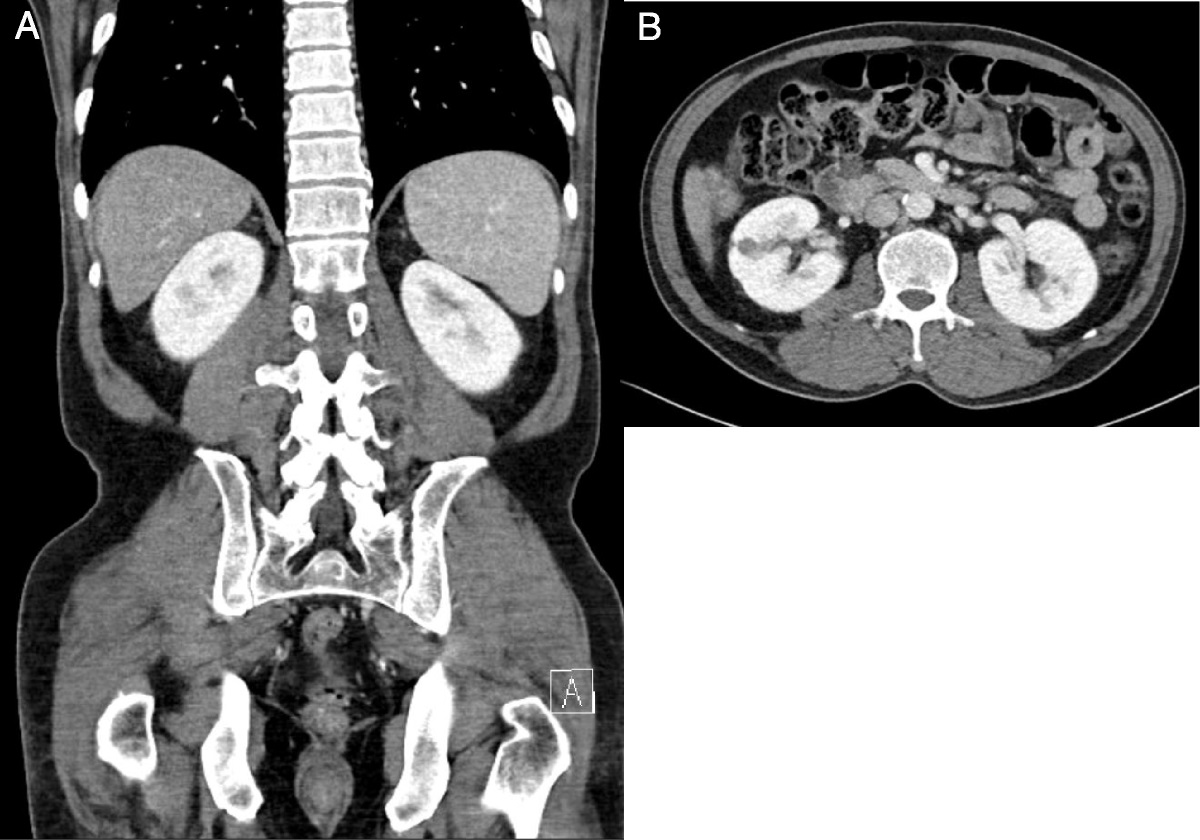 FDG PET/CT in Hantavirus Hemorrhagic Fever With Renal Syndrome