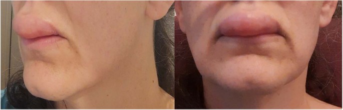 Prediction and prevention of ACE-inhibitor-induced angioedema—an unmet clinical need in management of hypertension