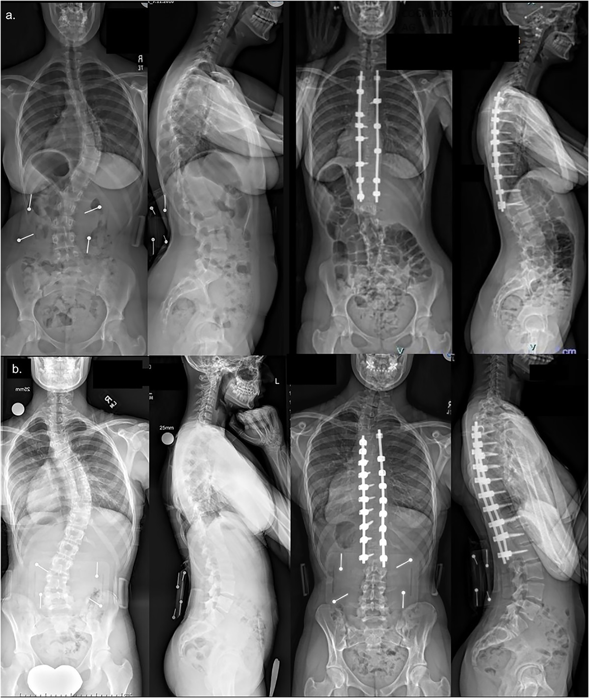 The Effect of Implant Density on Adolescent Idiopathic Scoliosis Fusion: Results of the Minimize Implants Maximize Outcomes Randomized Clinical Trial