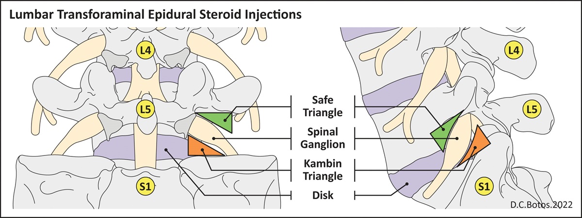 Pro-Con Debate: Superior Versus Inferior Triangle Needle Placement in Transforaminal Epidural Injections