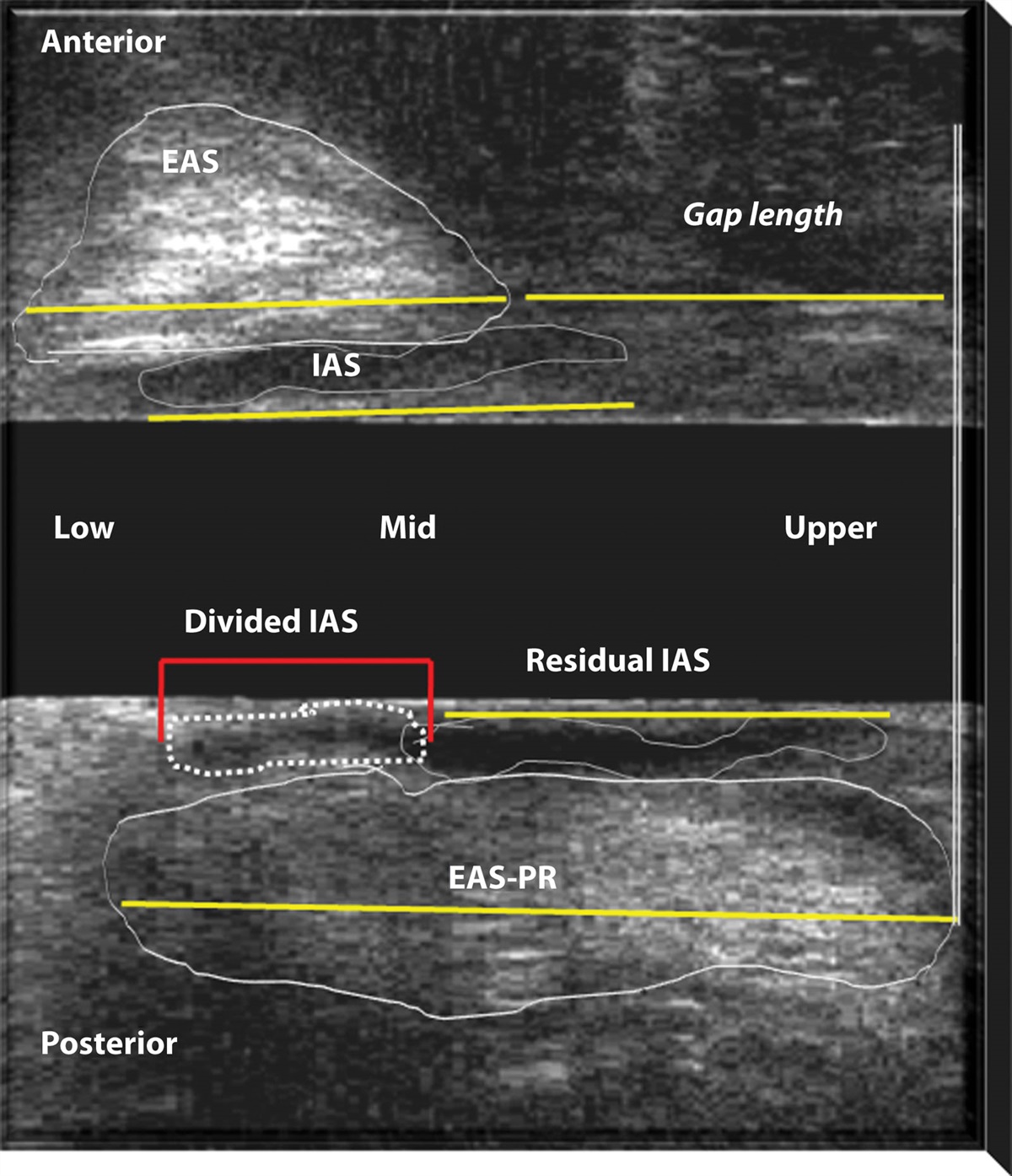 Impact of Internal Anal Sphincter Division on Continence Disturbance in Female Patients