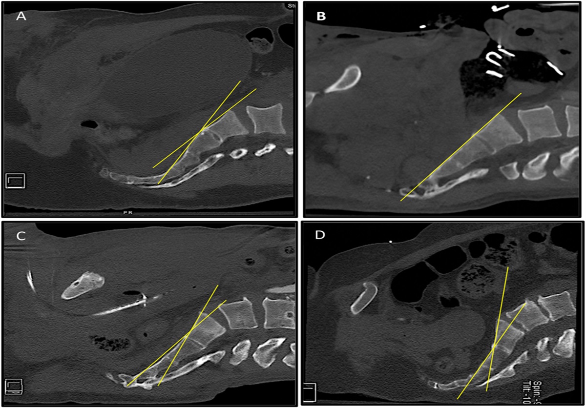 Iliosacral Screws Can Be Placed With Precision by Adjusting the Pelvic Inlet Between S1 and S2