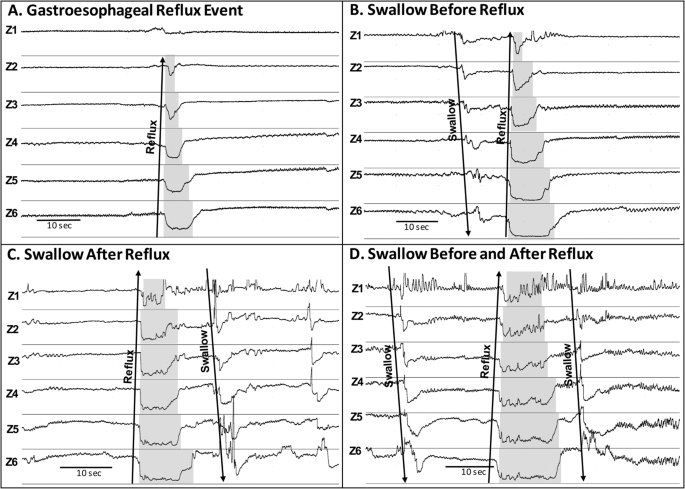 Characteristics of esophageal refluxate and symptoms in infants compared between pre-treatment and on treatment with proton pump inhibitors