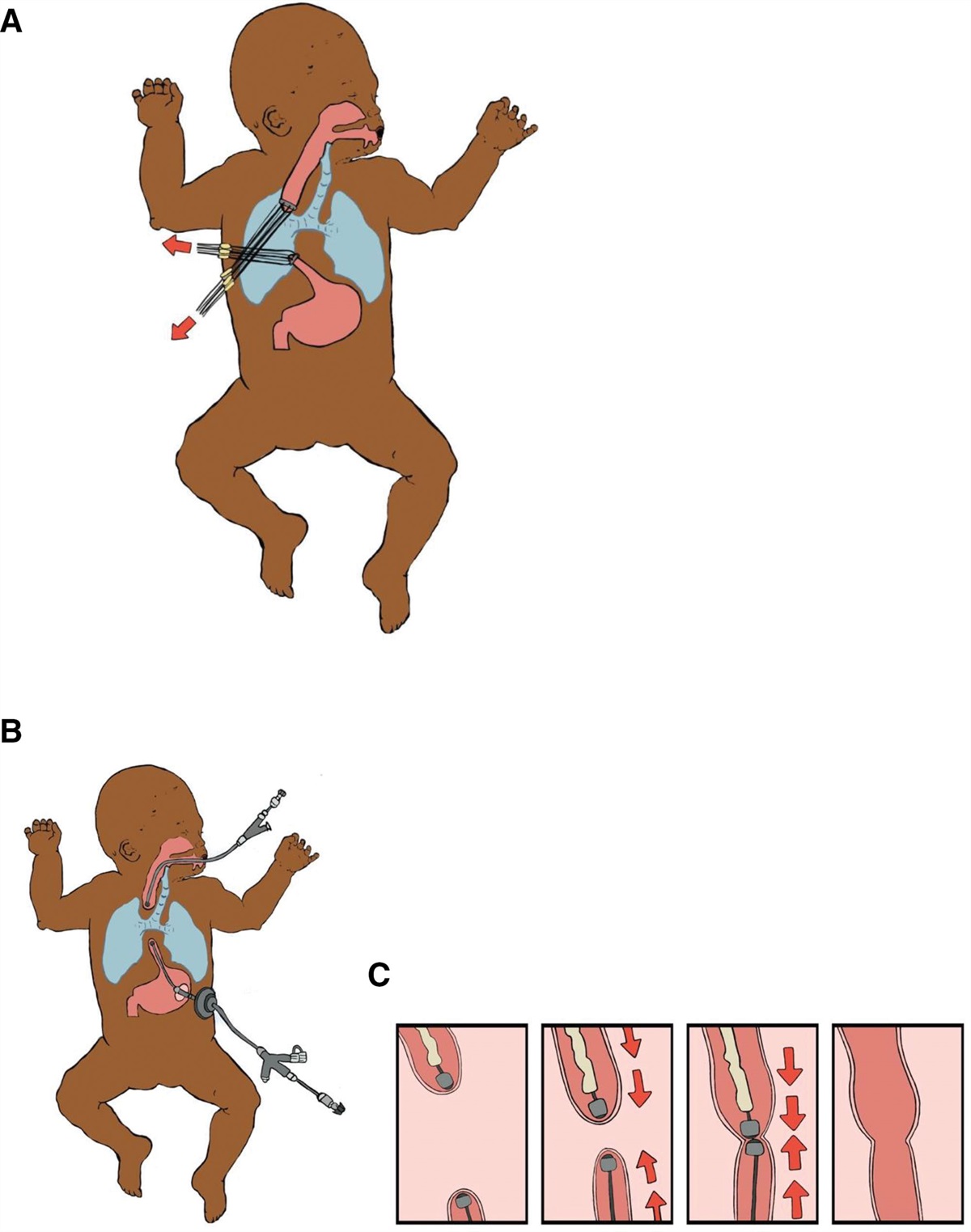 Recent Advances in the Genetic Pathogenesis, Diagnosis, and Management of Esophageal Atresia and Tracheoesophageal Fistula: A Review