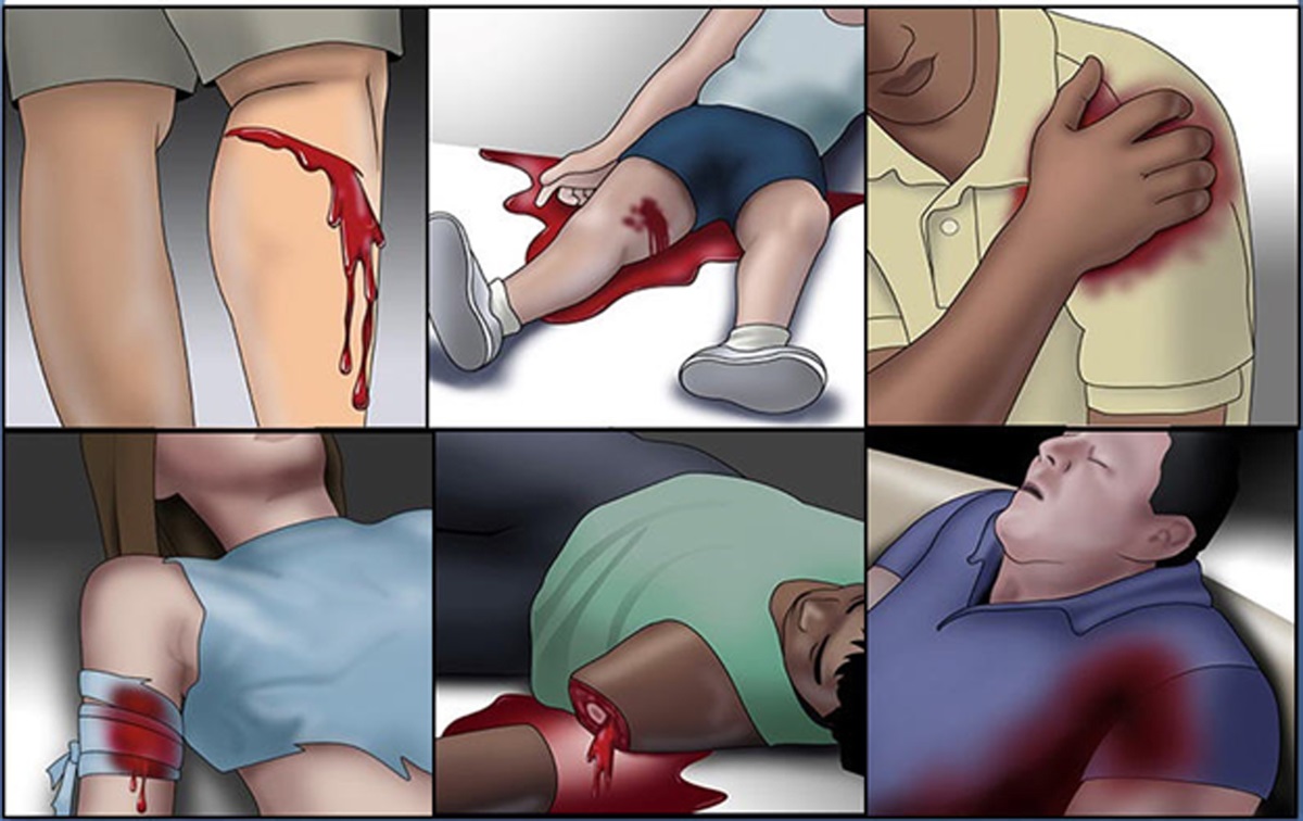 Rethinking limb tourniquet conversion in the prehospital environment