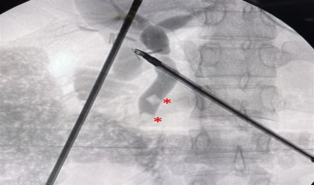 Contemporary management of common bile duct stone: What you need to know