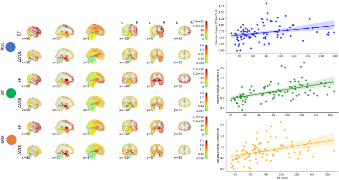 Electroconvulsive therapy-induced volumetric brain changes converge on a common causal circuit in depression