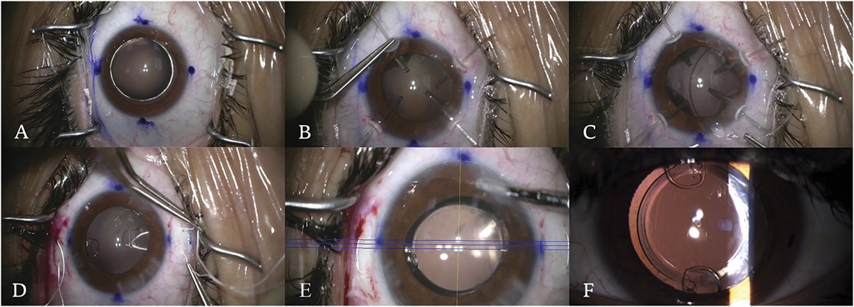 Comprehensive approach for capsular bag fixation in subluxated crystalline lens: preserving the anterior/posterior anatomical segment barrier