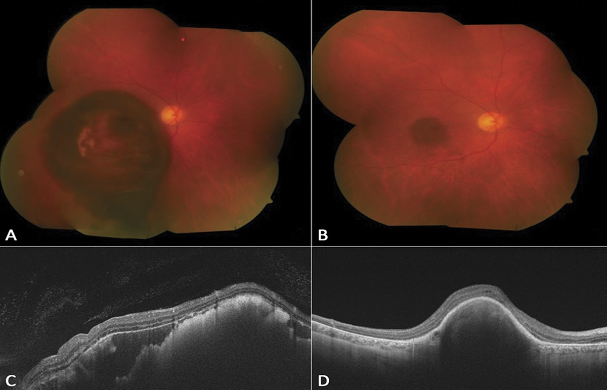 Displacement of Submacular Hemorrhage With Vitrectomy Combined With Subretinal Balanced Salt Solution and Air