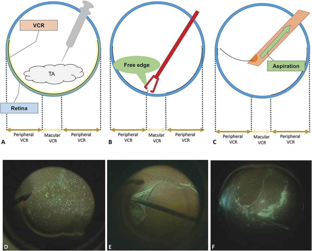 Vitreous Cortex Remnants Removal With Beveled Vitrectomy Probe During Vitrectomy For Primary Rhegmatogenous Retinal Detachment