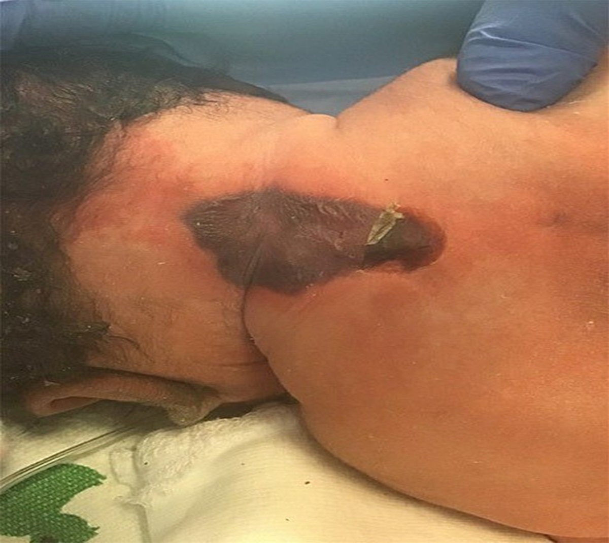 A Unique Case of Intrauterine Pressure Injury