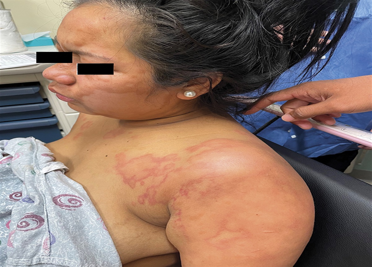 Type 2 Leprosy Reaction Mimicking Leukocytoclastic Vasculitis in a Postpartum Patient