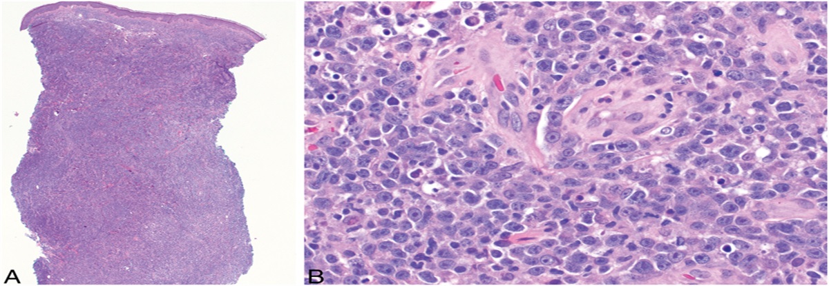 Navigating the Complexity of Dual Clonality in Cutaneous Lymphoma: Challenge