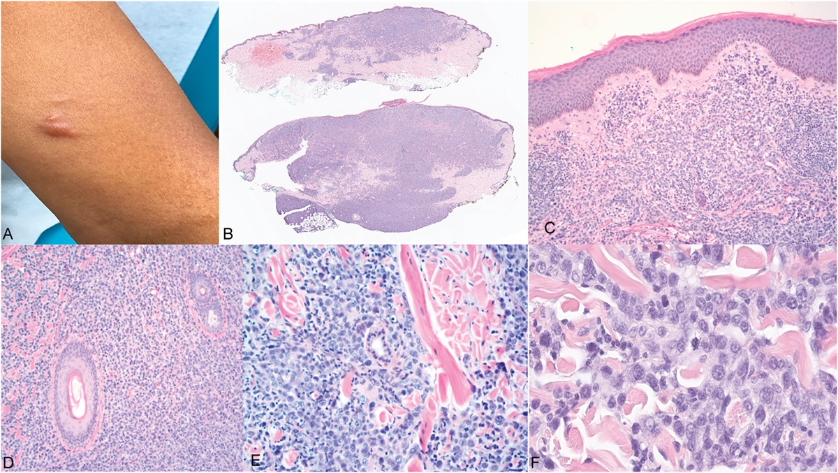 DUSP22-IRF4 Rearranged CD30-Positive Primary Cutaneous Lymphoproliferative Disorder With Gamma/Delta Phenotype