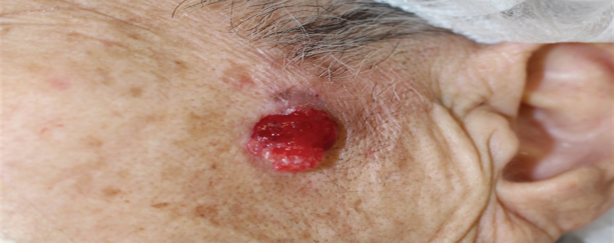 A Case of Biphenotypic Adnexal Carcinoma With Bowenoid and Basaloid Features: Focus on the Expression of SOX9 and Wnt Signaling Pathway Molecules, Including CDX2