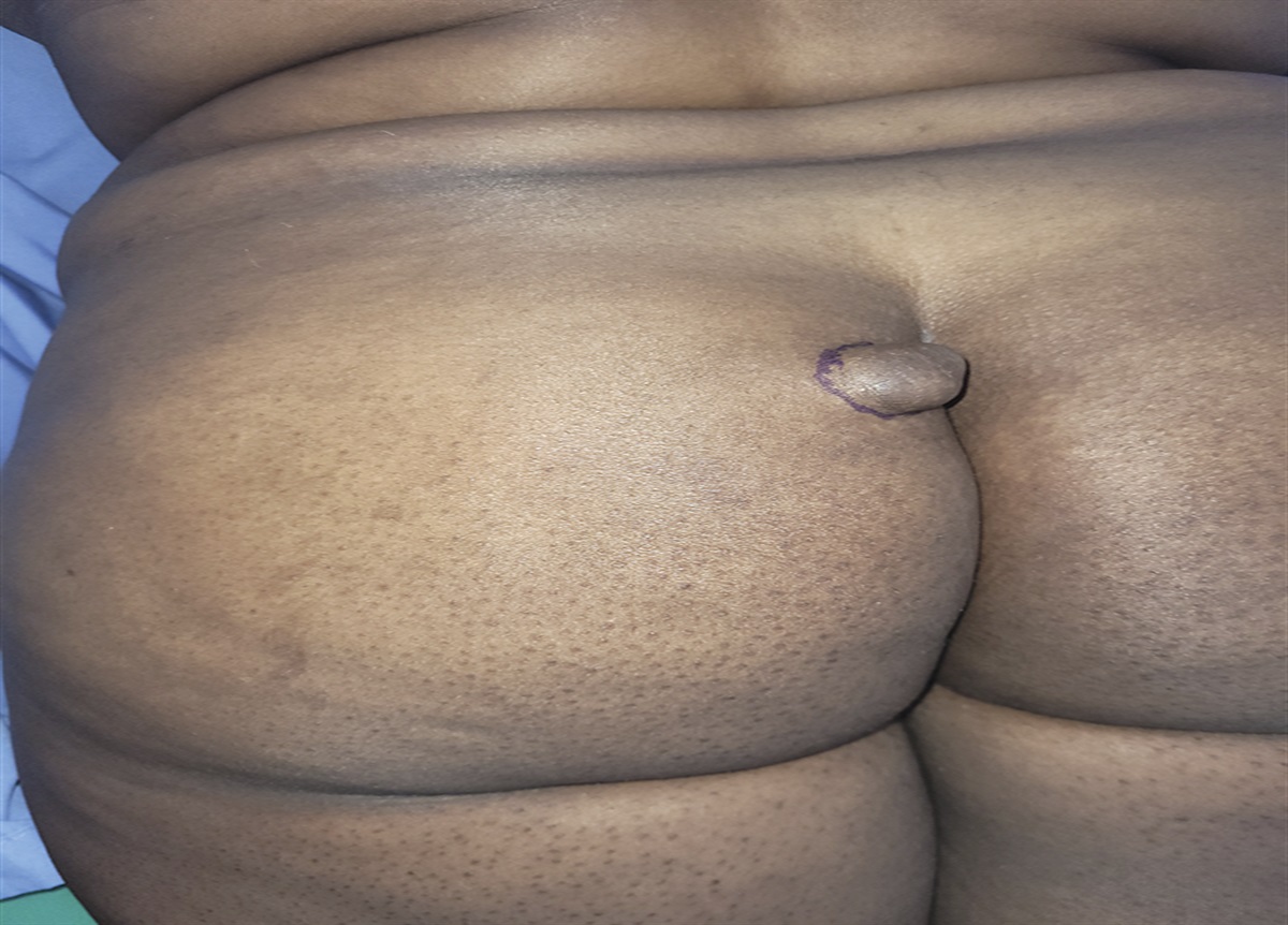 A 32-Year-Old Afro-Caribbean Female With a Slow-Growing Nodule on the Left Buttock: Challenge